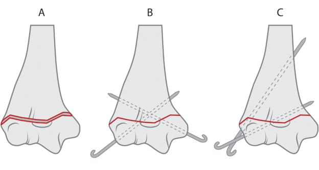 t fracture elbow